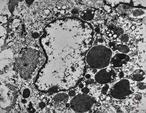 M,61y. | spleen - hemangioma v.s. … erythrophagocytosis